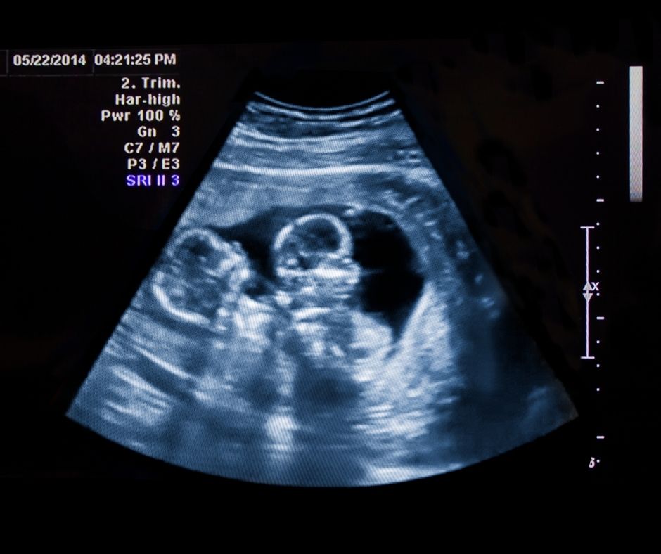 Ciąża wielopłodowa obraz USG - blog helloskarbie.pl