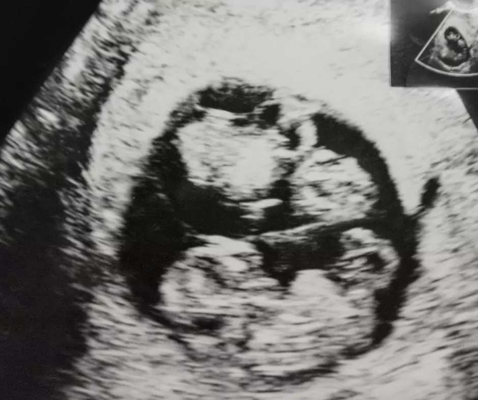 Objawy w ciąży bliźniaczej - blog helloskarbie.pl